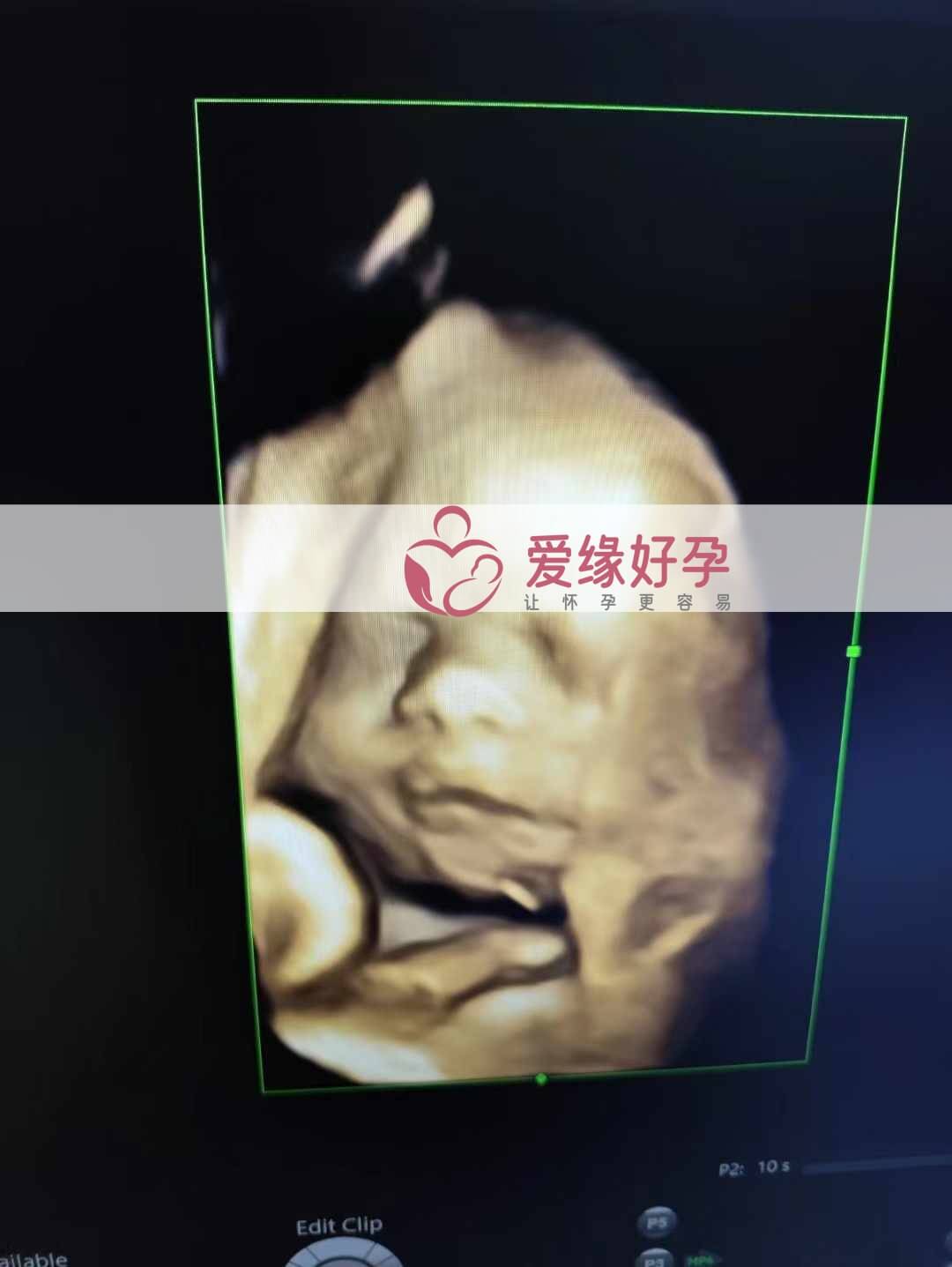 爱缘好孕乌克兰代孕代母孕34周产检顺利通过