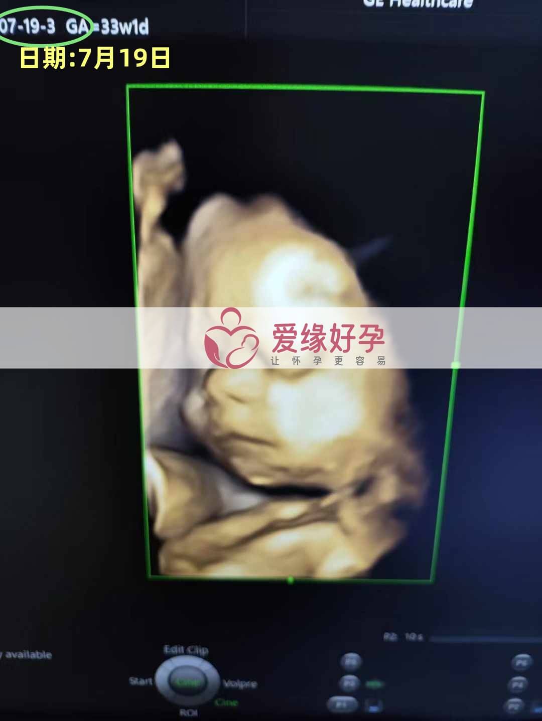 爱缘好孕乌克兰代孕代母孕34周产检顺利通过