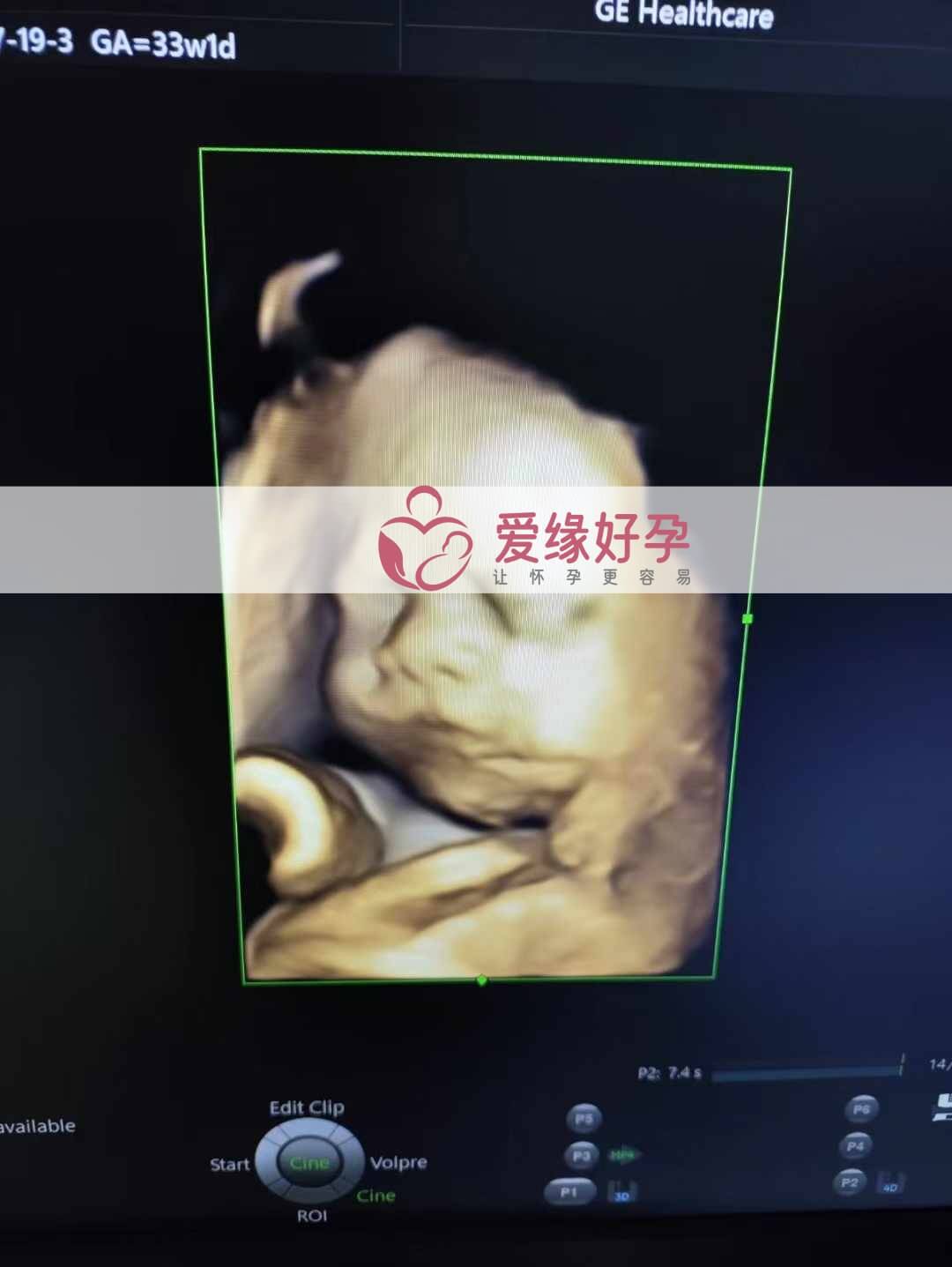 爱缘好孕乌克兰代孕代母孕34周产检顺利通过