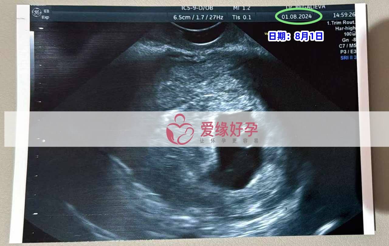 爱缘好孕哈萨克斯坦代孕代母B超产检顺利通过