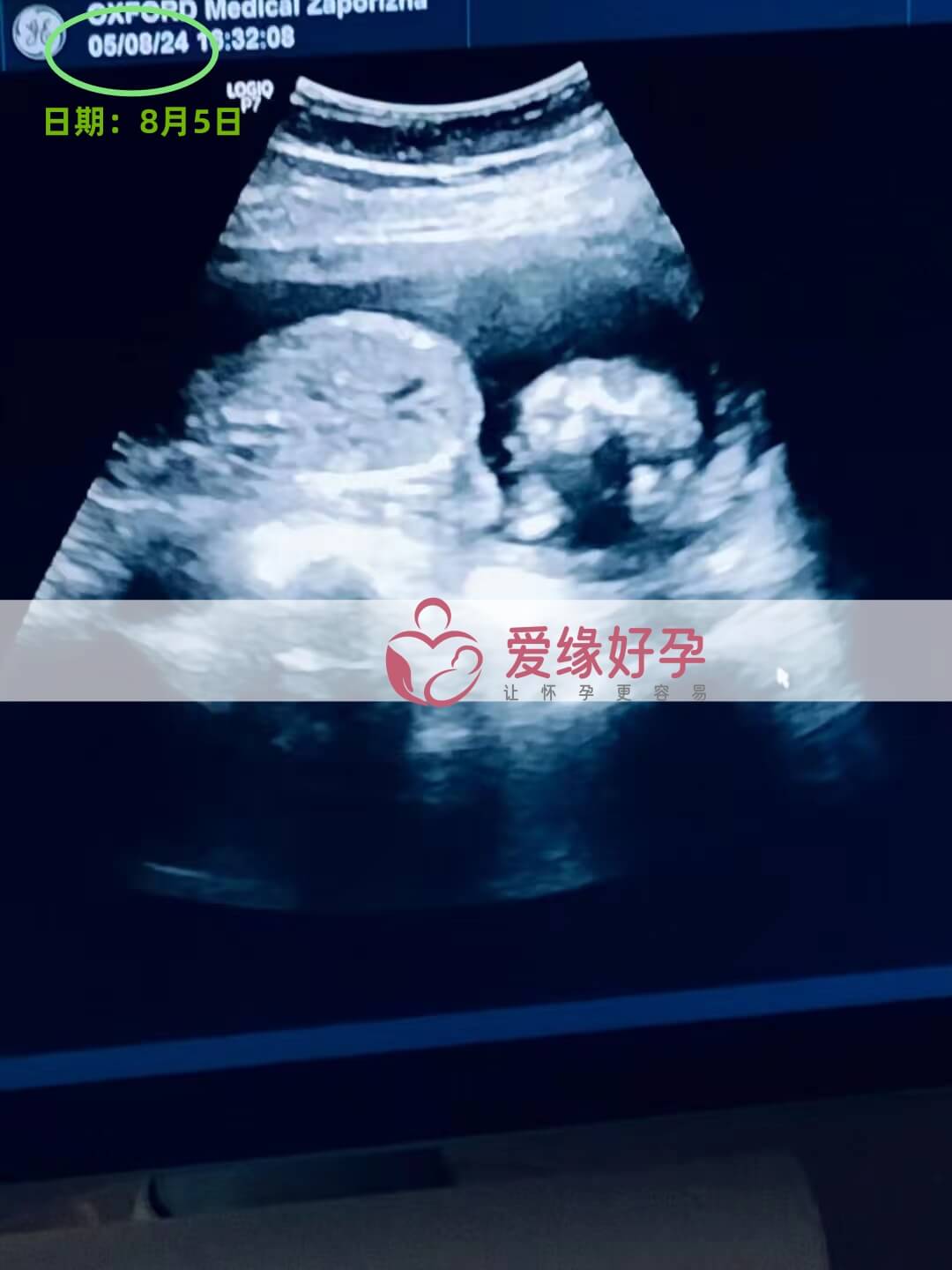 爱缘好孕乌克兰代孕代母17周孕检通过！