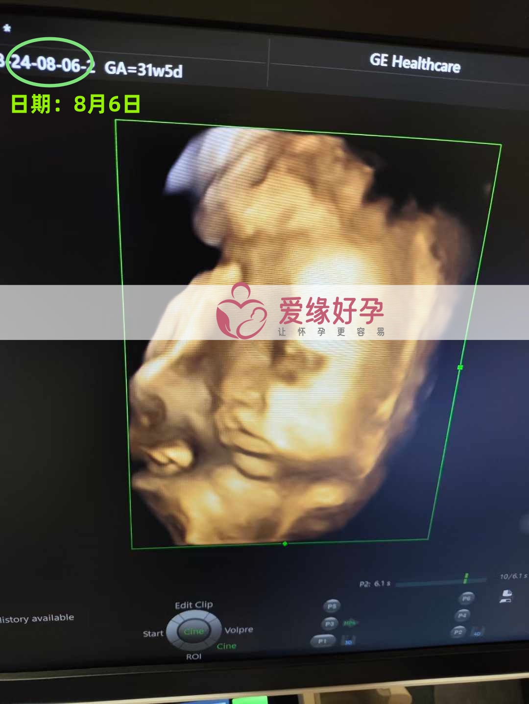 爱缘好孕乌克兰代孕代母31周孕检通过！