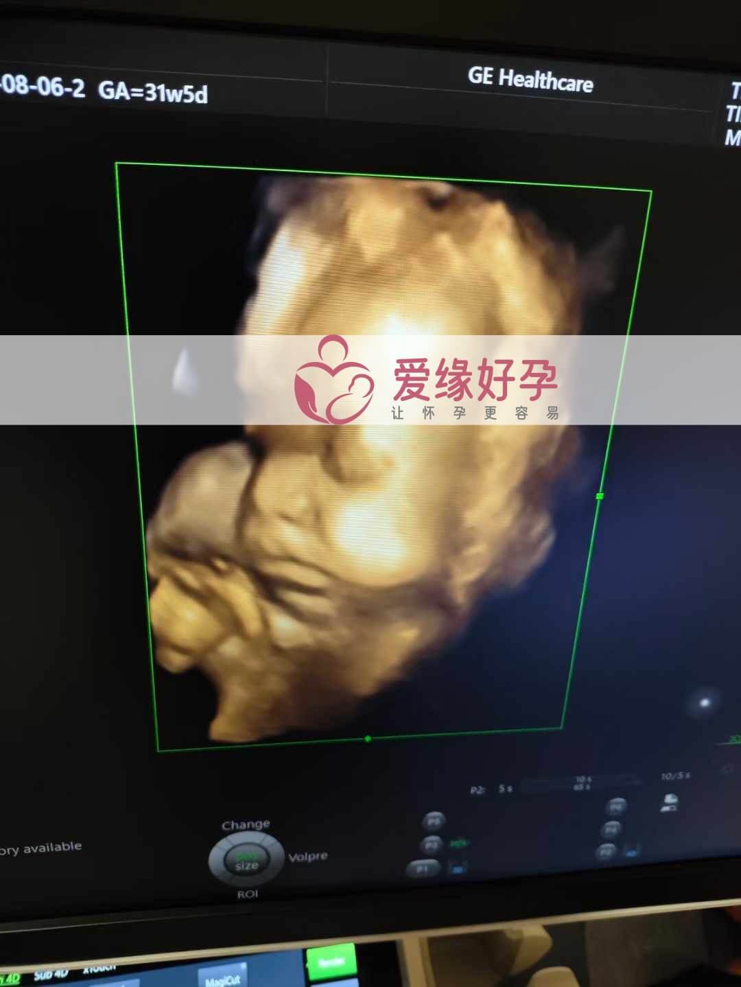 爱缘好孕乌克兰代孕代母31周孕检通过！