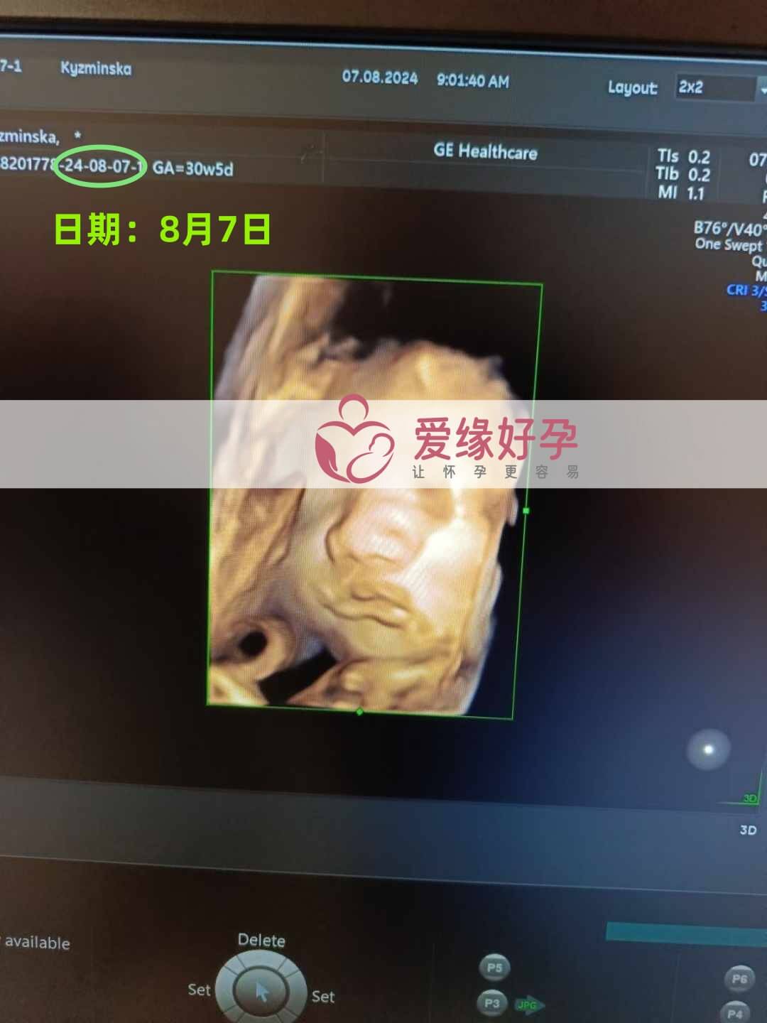 爱缘好孕乌克兰代孕代母30周孕检通过！