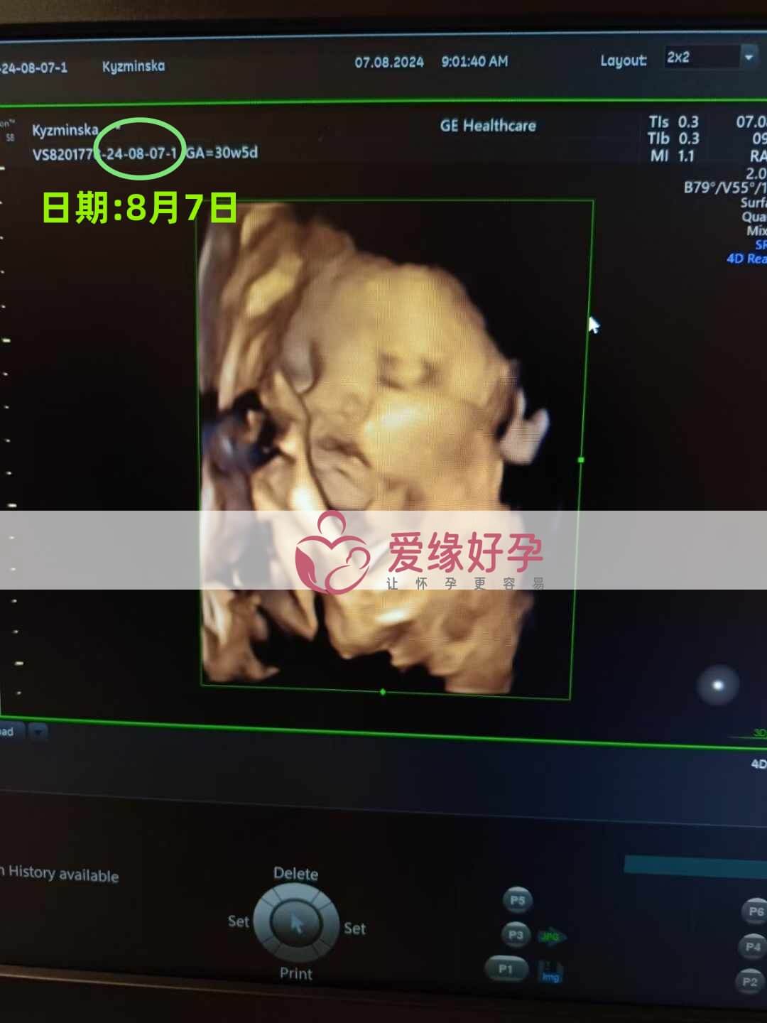 爱缘好孕乌克兰代孕代母30周孕检通过！