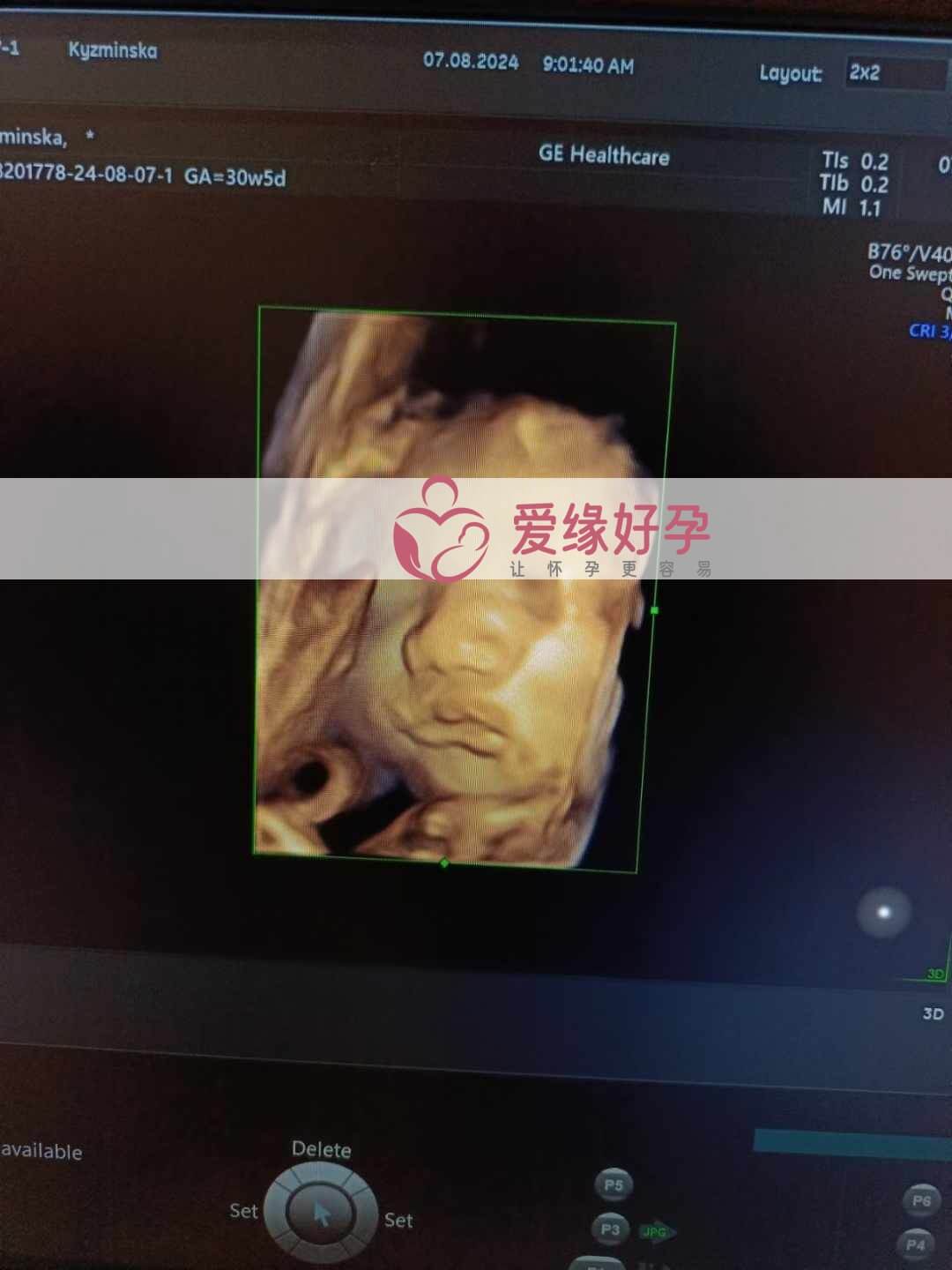 爱缘好孕乌克兰代孕代母30周孕检通过！