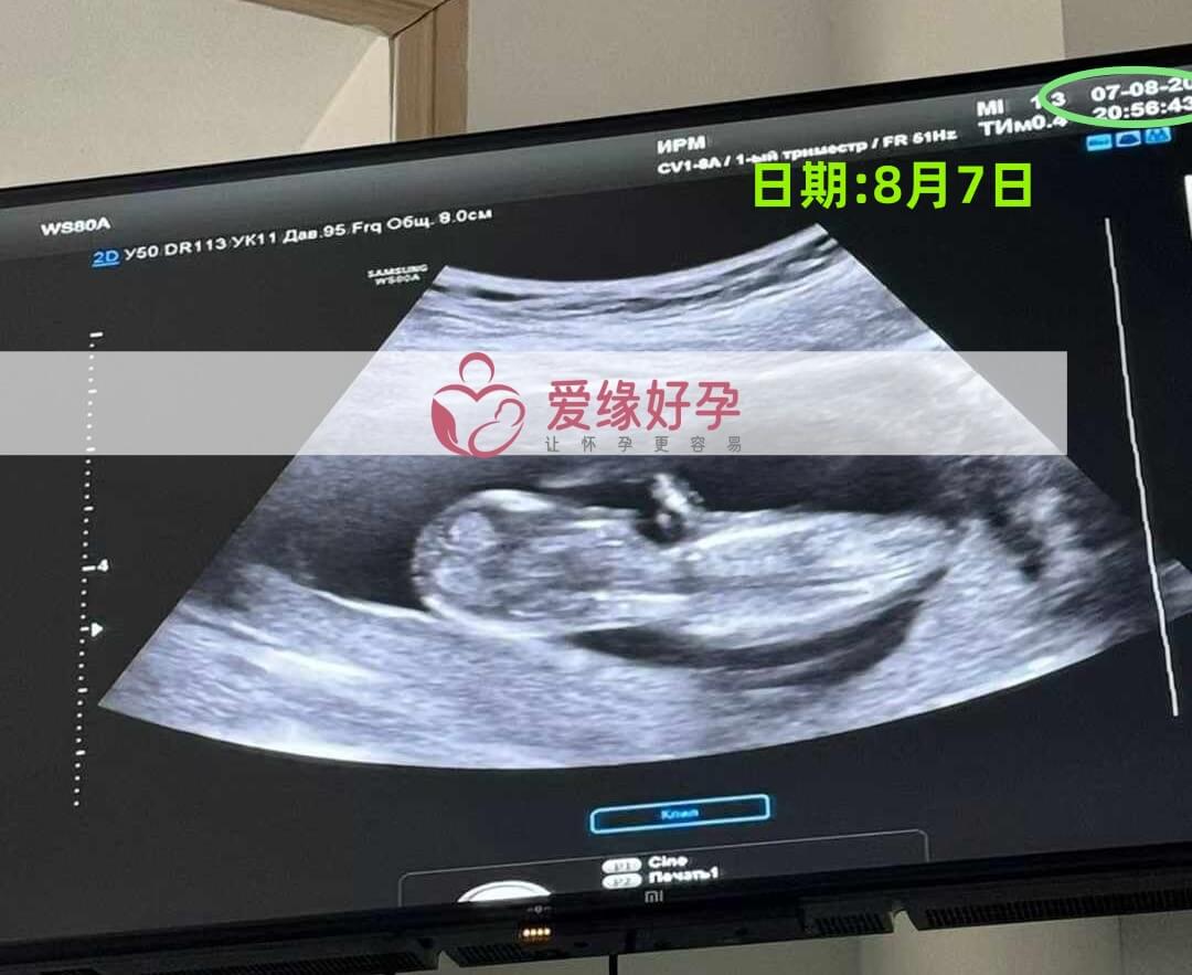 爱缘好孕哈萨克斯坦代孕代母12周孕检通过！