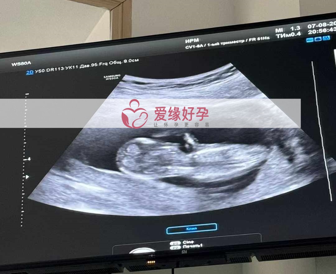 爱缘好孕哈萨克斯坦代孕代母12周孕检通过！
