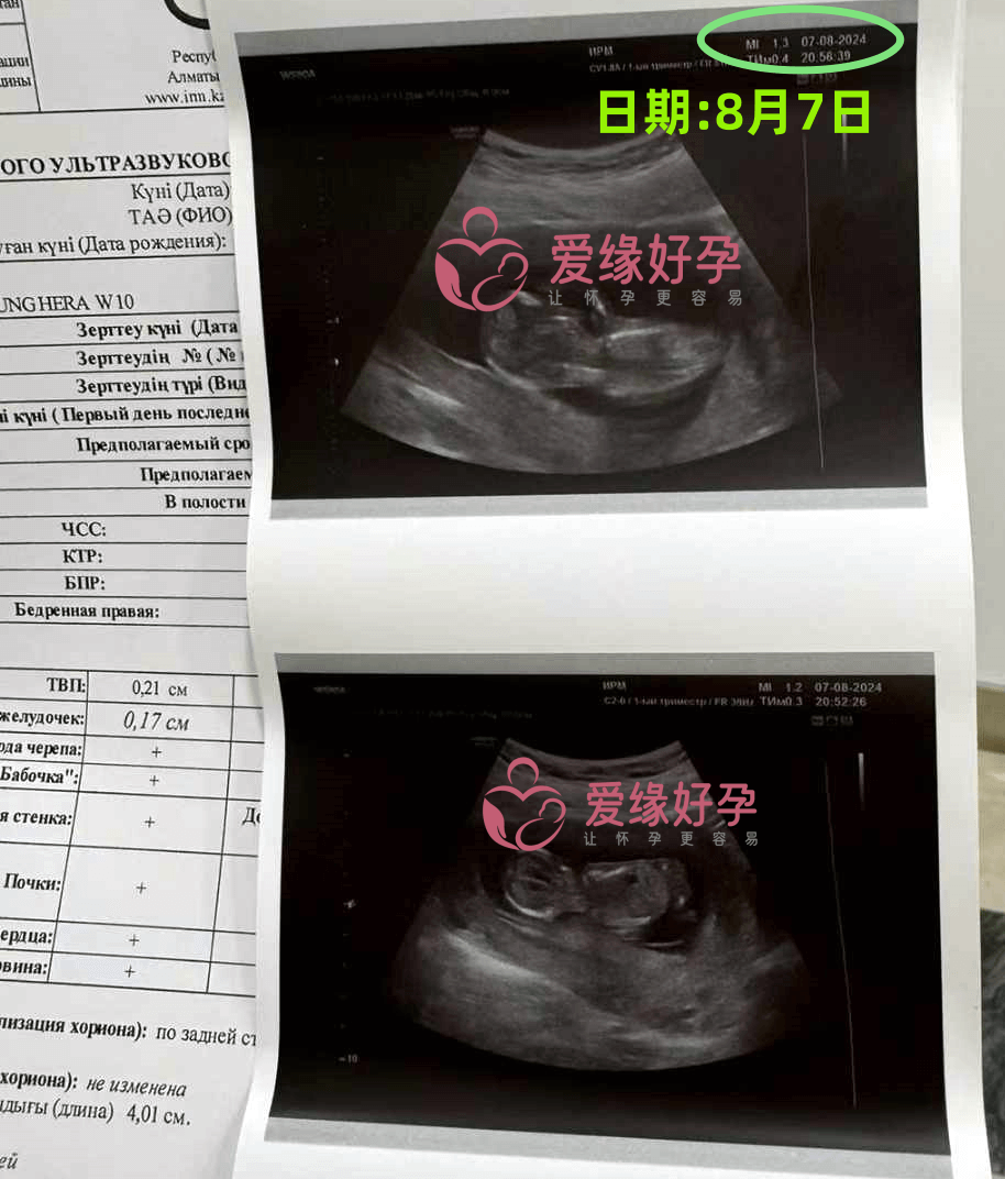 爱缘好孕哈萨克斯坦代孕代母12周孕检通过！