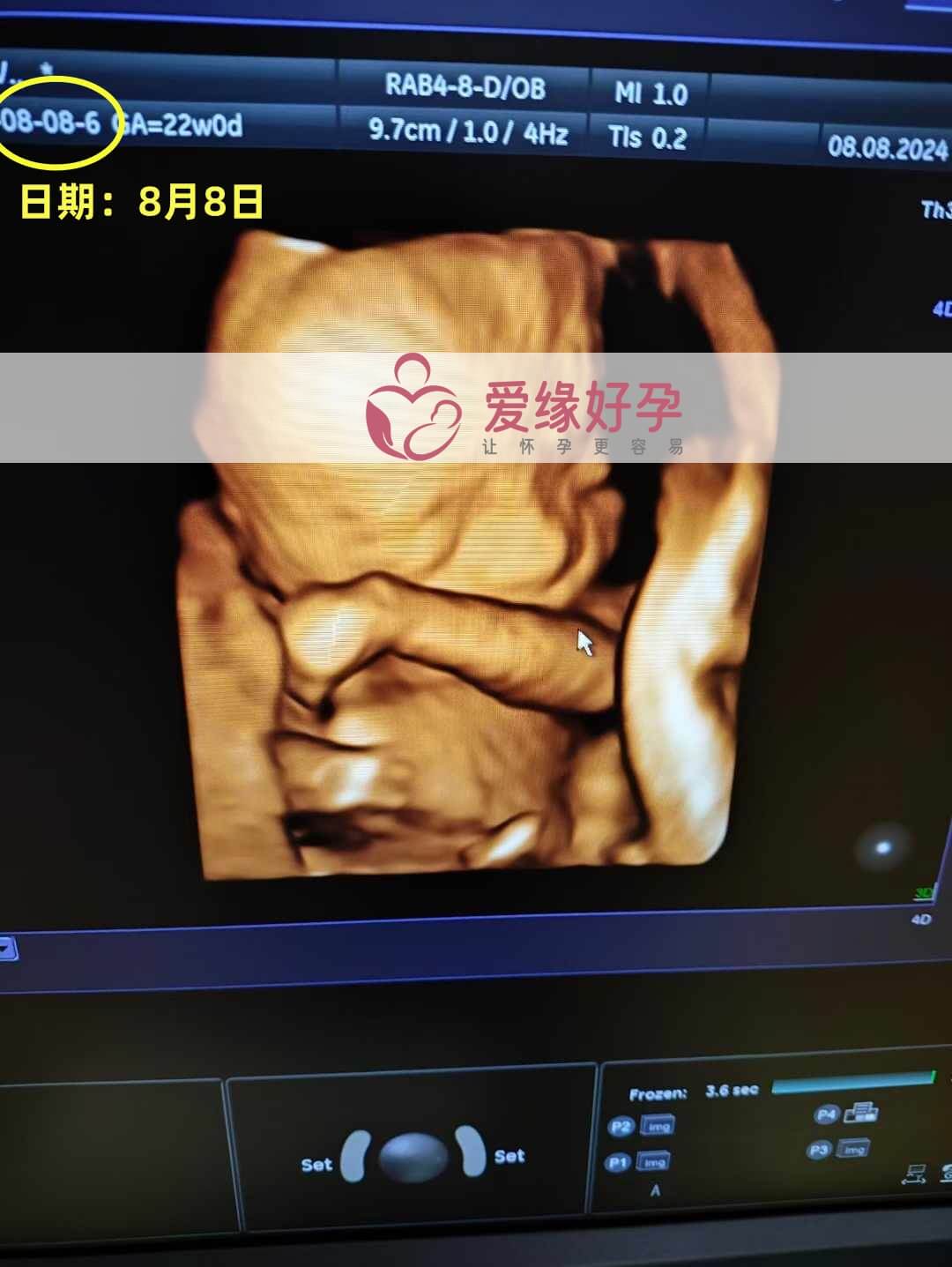 爱缘好孕乌克兰代孕代母21周孕检通过！