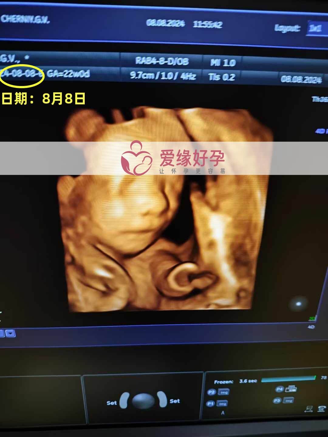 爱缘好孕乌克兰代孕代母21周孕检通过！