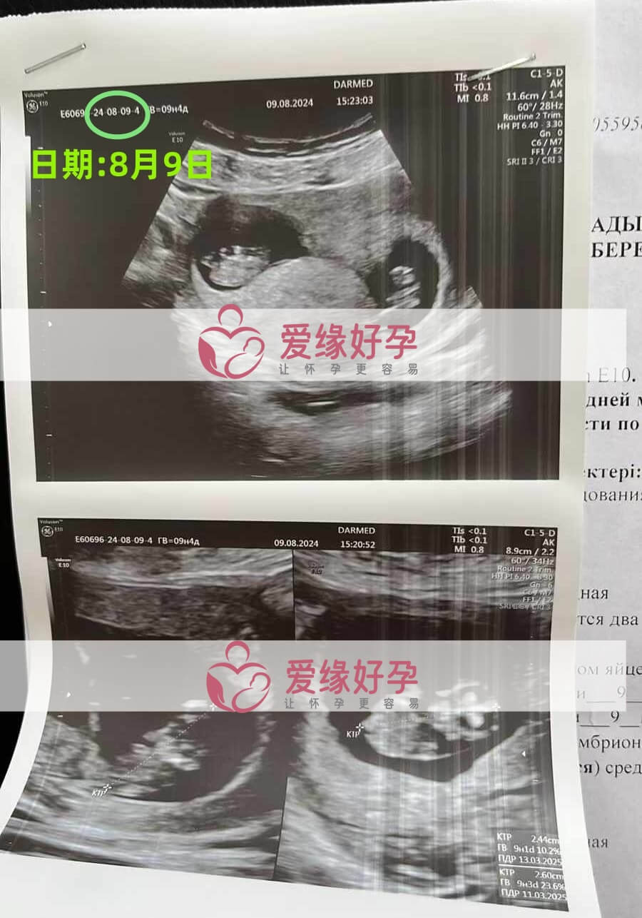 爱缘好孕格鲁吉亚代孕代母孕9周产检顺利通过！
