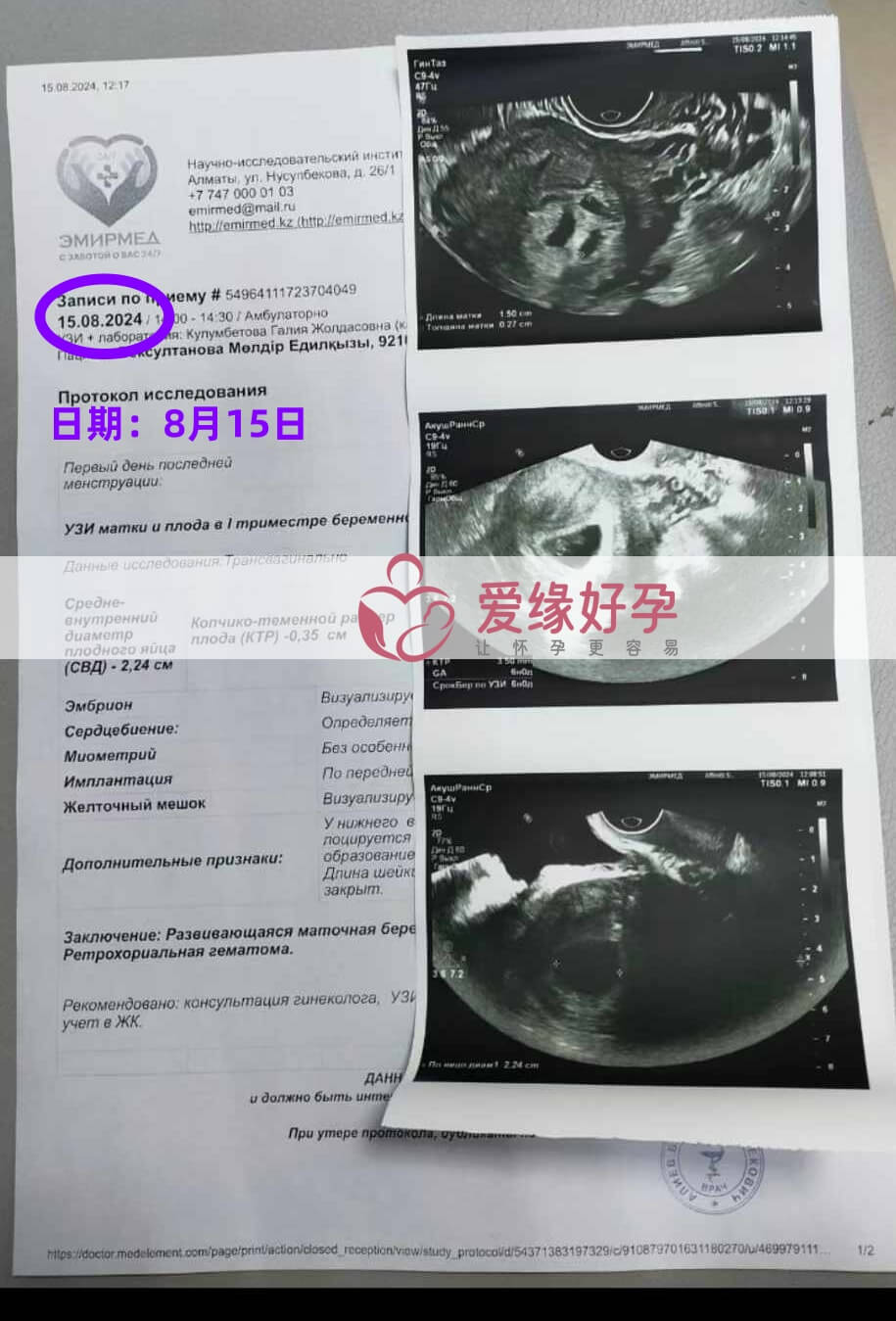 爱缘好孕哈萨克斯坦代孕代母B超产检通过！