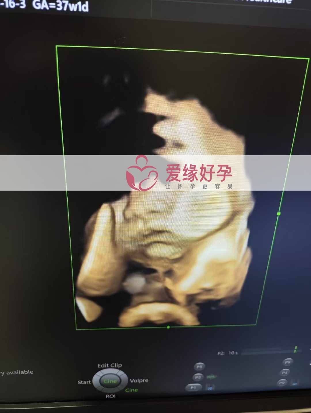 爱缘好孕乌克兰代孕代母孕37周产检顺利通过！