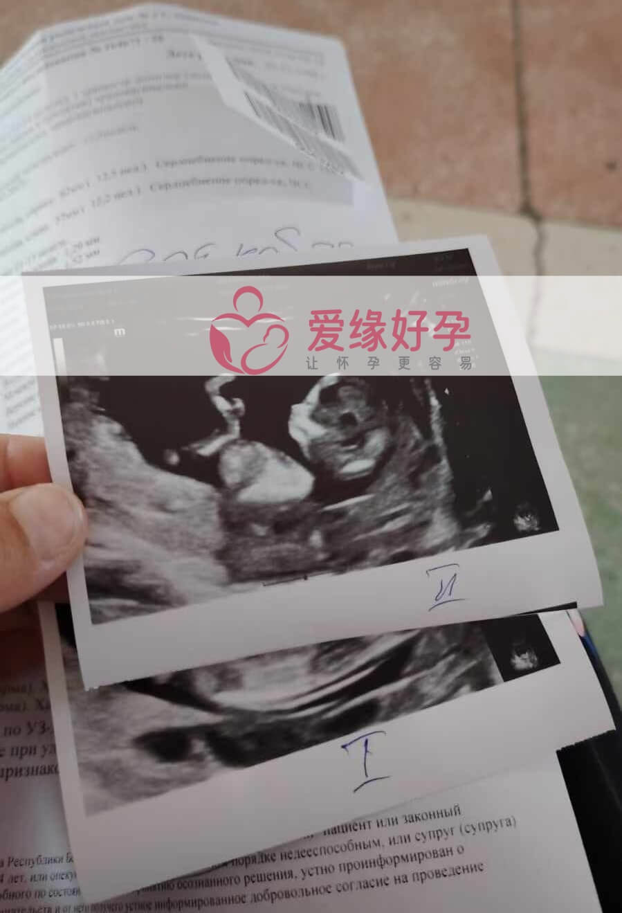 爱缘好孕格鲁吉亚代孕代母NT产检通过！