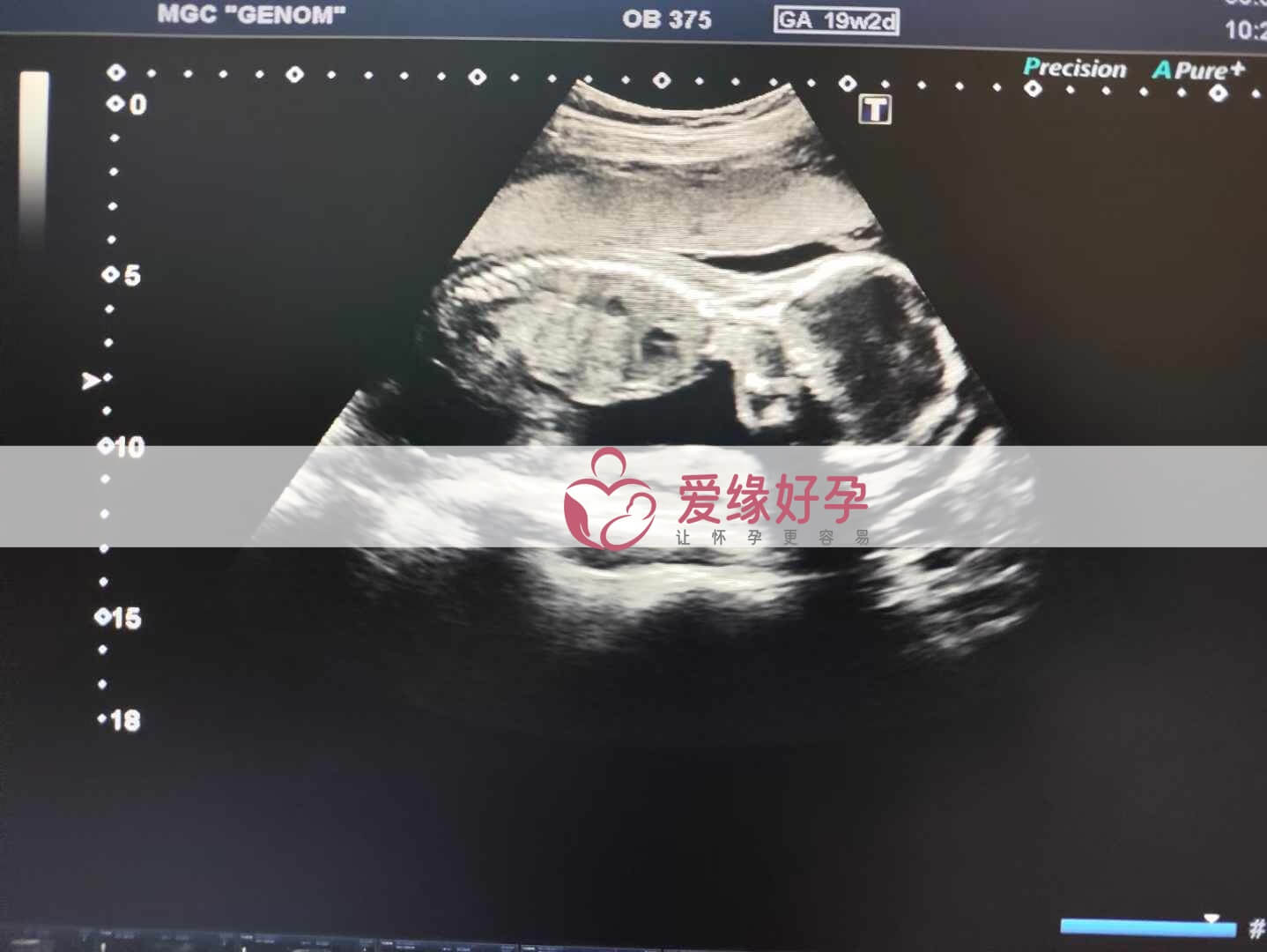 乌克兰恩泽ENZE代孕代母孕20周产检顺利通过！