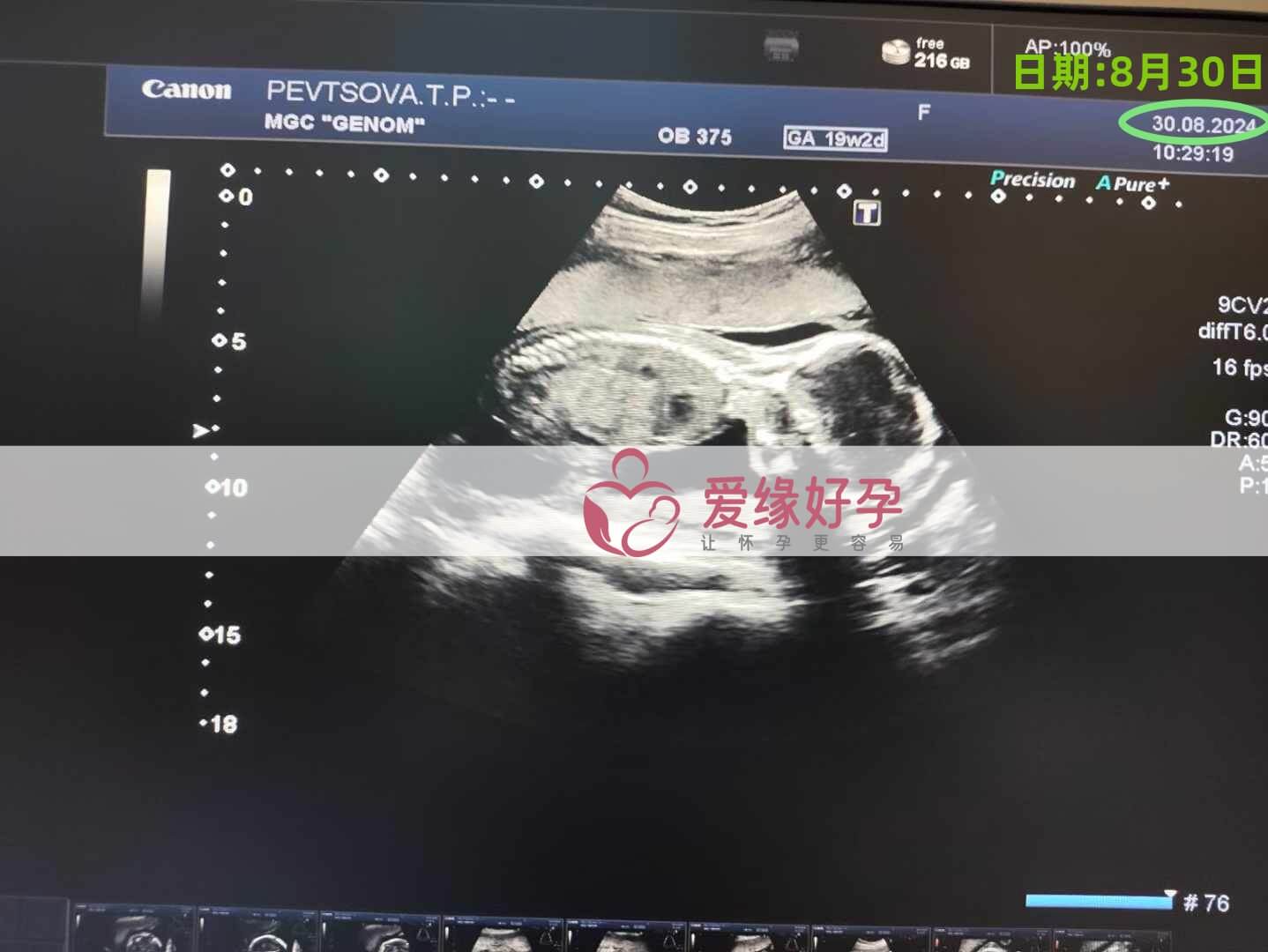 乌克兰恩泽ENZE代孕代母孕20周产检顺利通过！