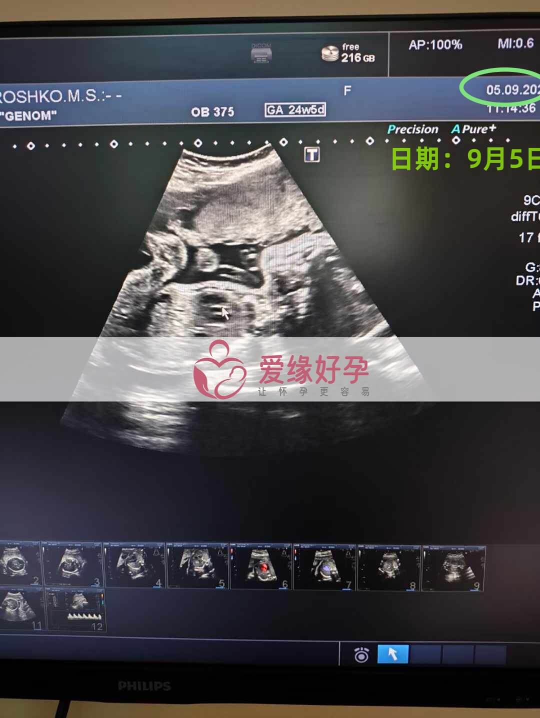 乌克兰恩泽代孕代母孕24周产检！