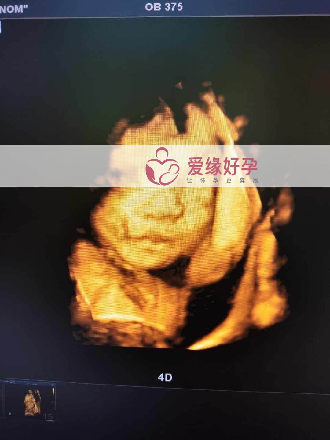 乌克兰恩泽代孕代母孕26周产检顺利通过！