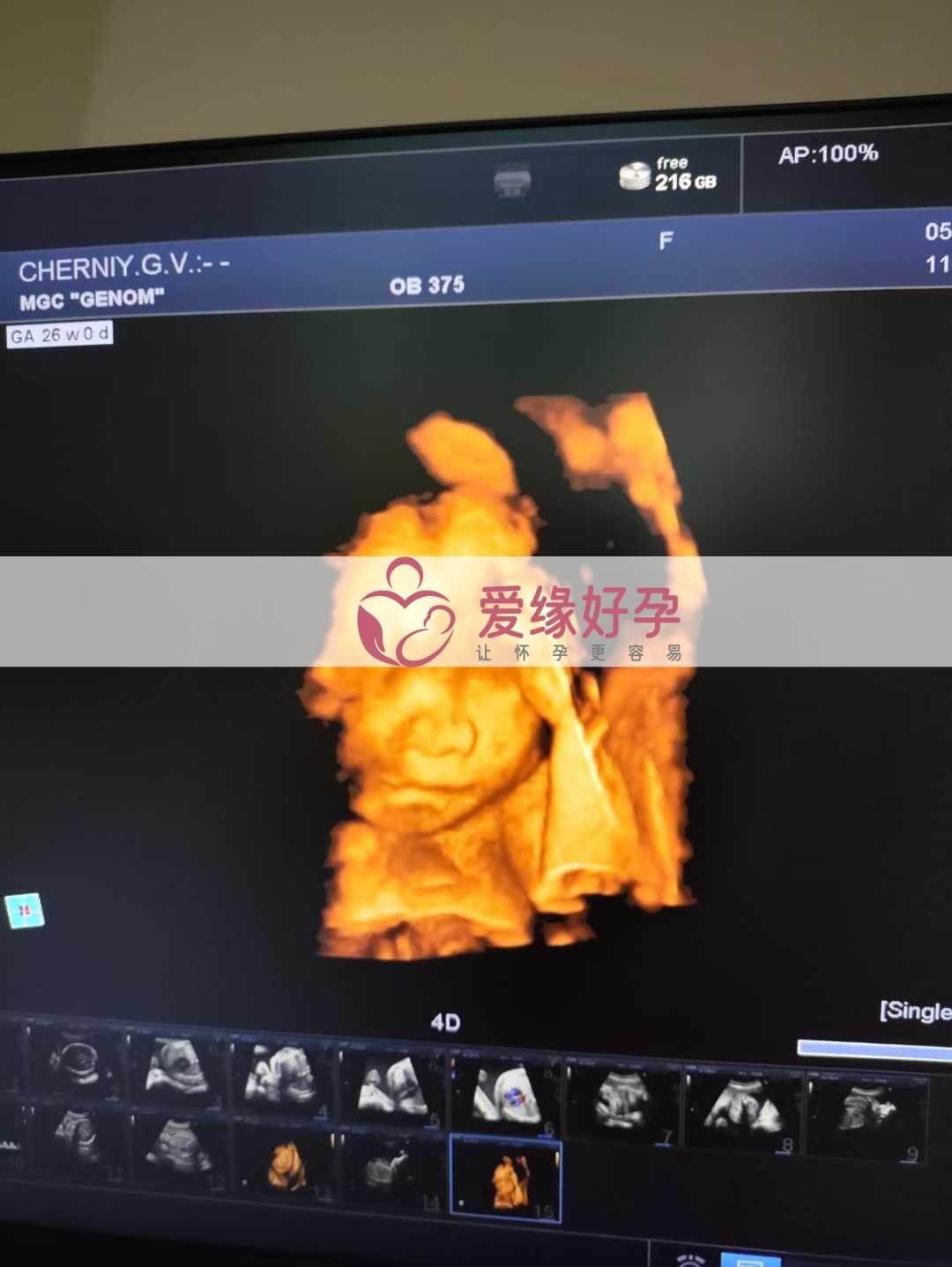 乌克兰恩泽代孕代母孕26周产检顺利通过！