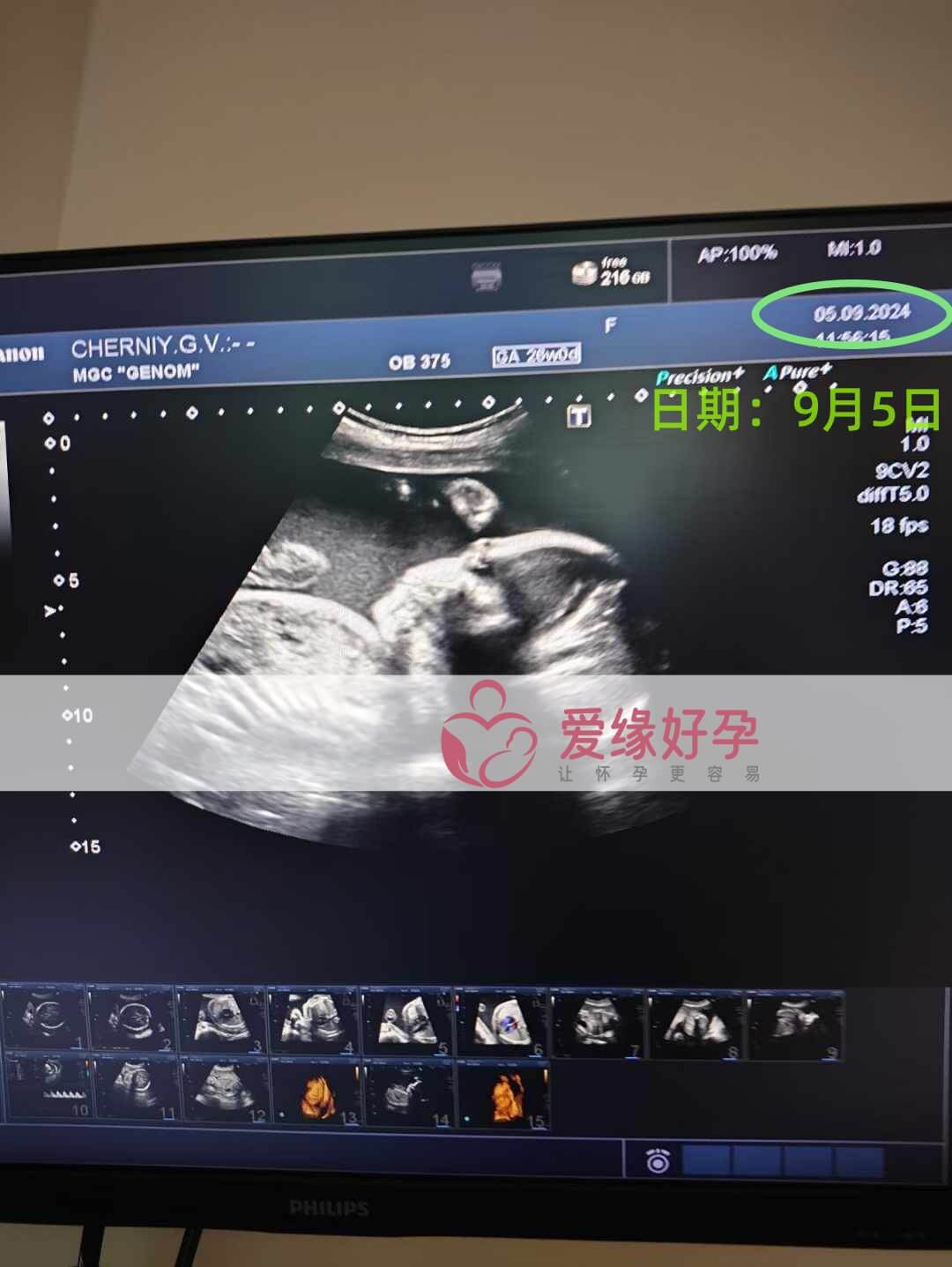 乌克兰恩泽代孕代母孕26周产检顺利通过！