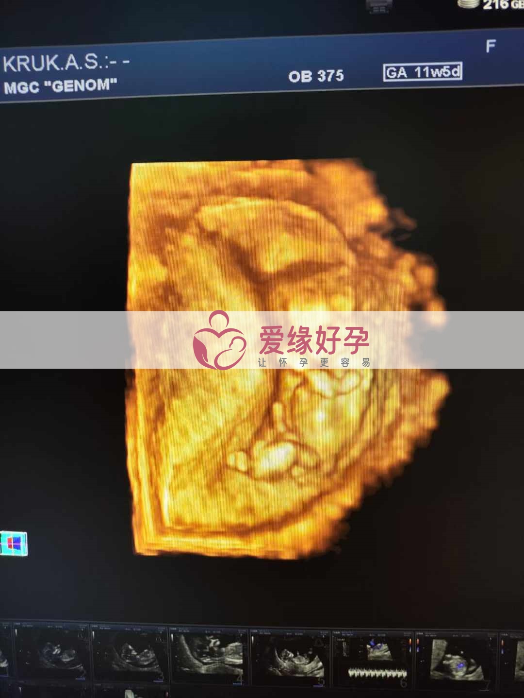 乌克兰恩泽代孕代母孕12周产检顺利通过！