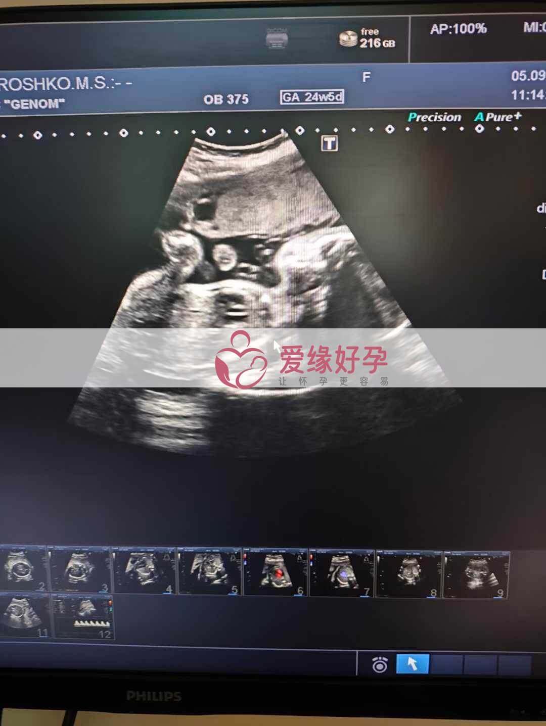 乌克兰恩泽代孕代母孕24周产检顺利通过