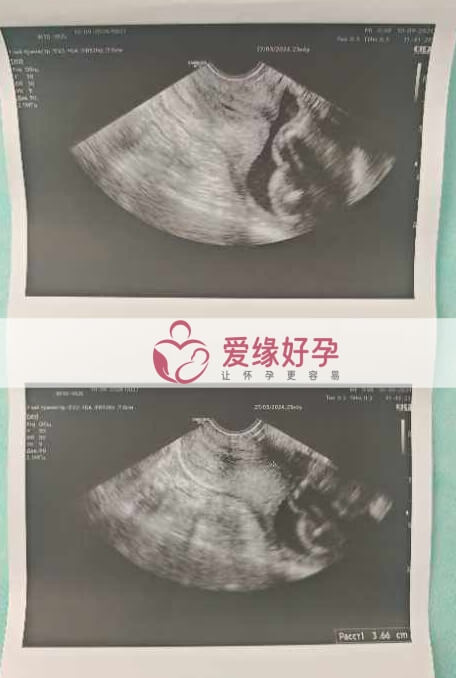 哈萨克斯坦恩泽代孕代母孕23周产检顺利通过