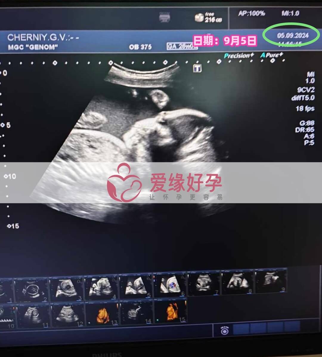 乌克兰恩泽代孕代母孕26周产检顺利通过