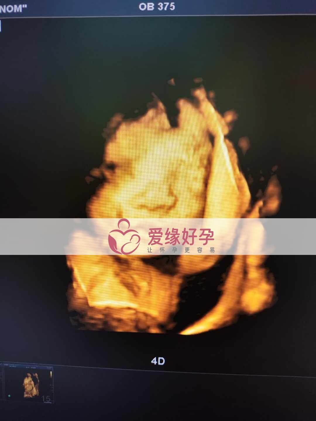 乌克兰恩泽代孕代母孕26周产检顺利通过