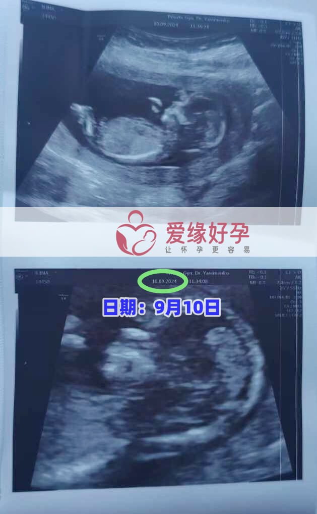 格鲁吉亚恩泽代孕代母孕13周产检顺利通过