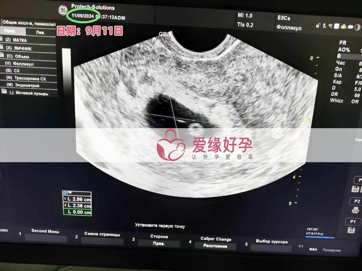 乌克兰代孕代母孕5周产检顺利通过 发布日期