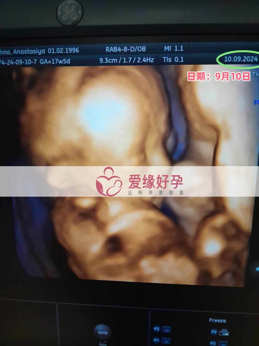 乌克兰代孕代母孕17周产检顺利通过