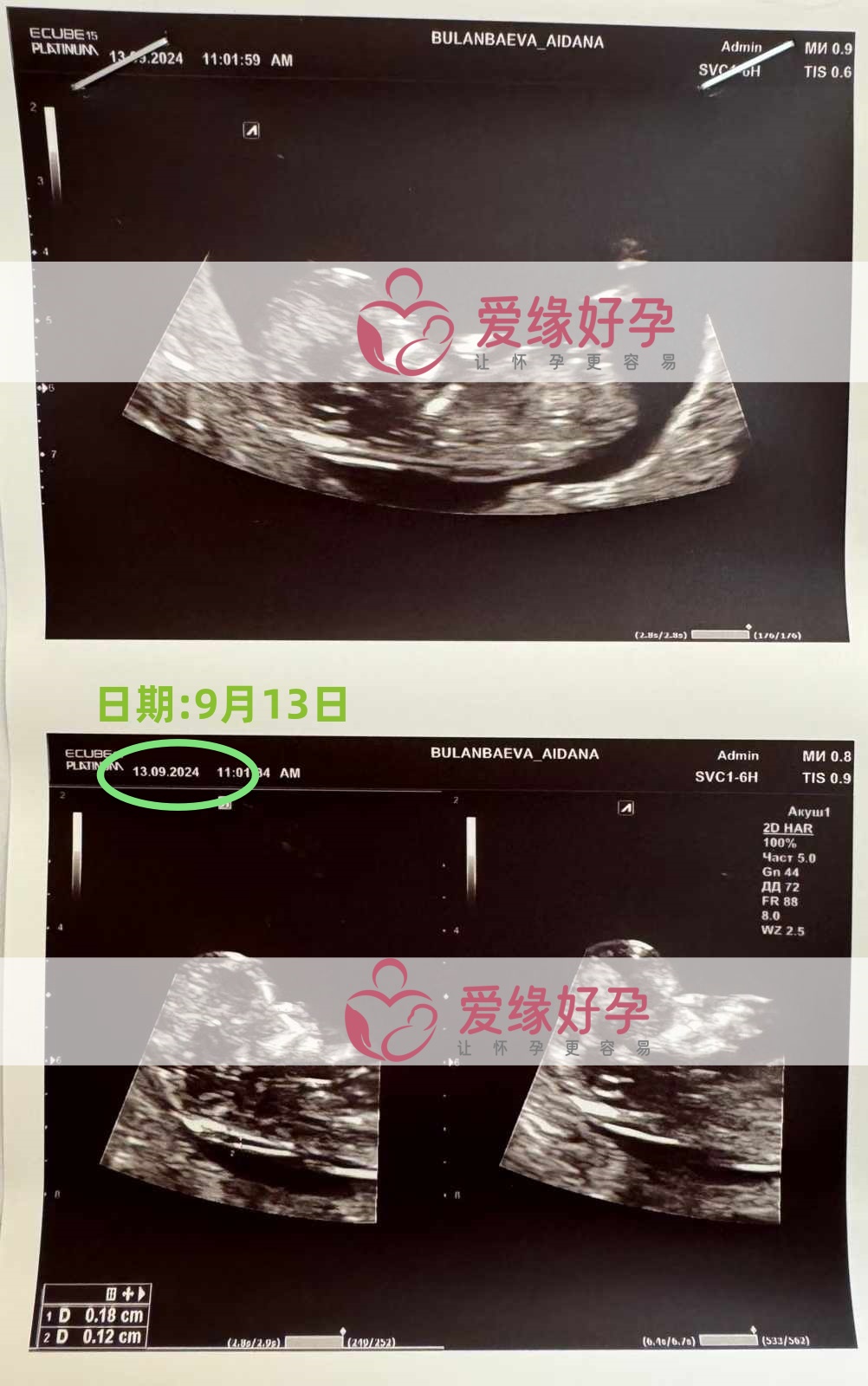 哈萨克斯坦代孕代母孕12周产检顺利通过