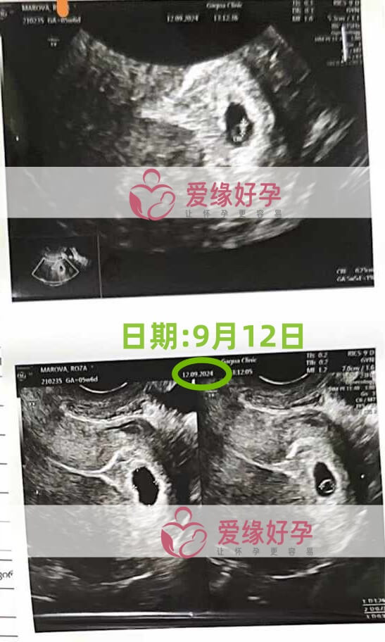 格鲁吉亚代孕代母第一次B超产检