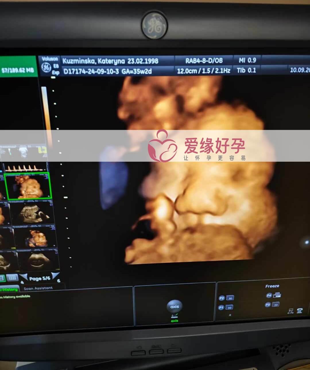 乌克兰代孕代母孕35周产检顺利通过