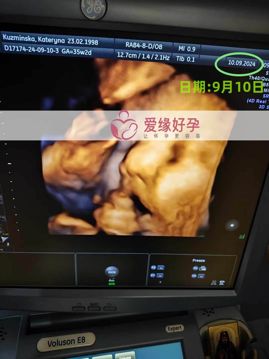 乌克兰代孕代母孕35周产检顺利通过