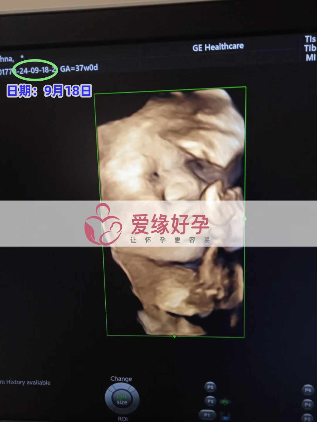 乌克兰代孕代母孕35周产检顺利通过！