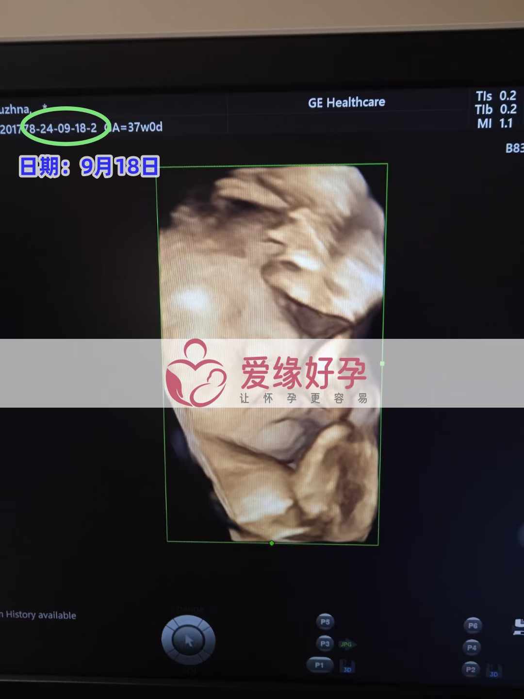 乌克兰代孕代母孕35周产检顺利通过！