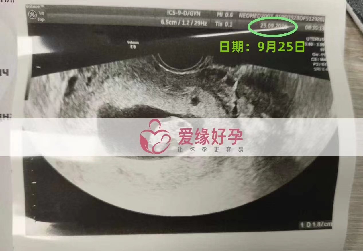 乌克兰代孕代母孕8周产检顺利通过
