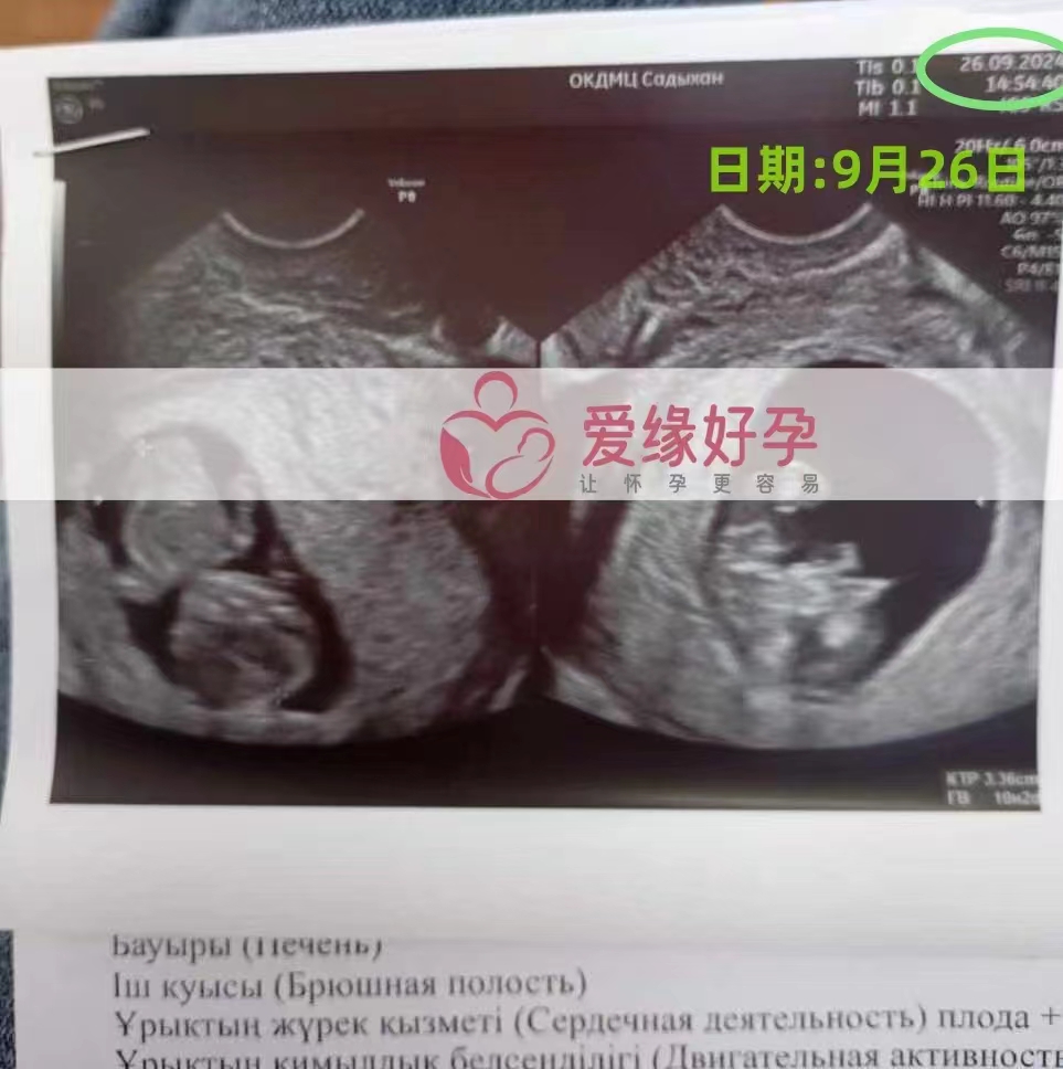 格鲁吉亚代孕代母孕10周产检顺利通过
