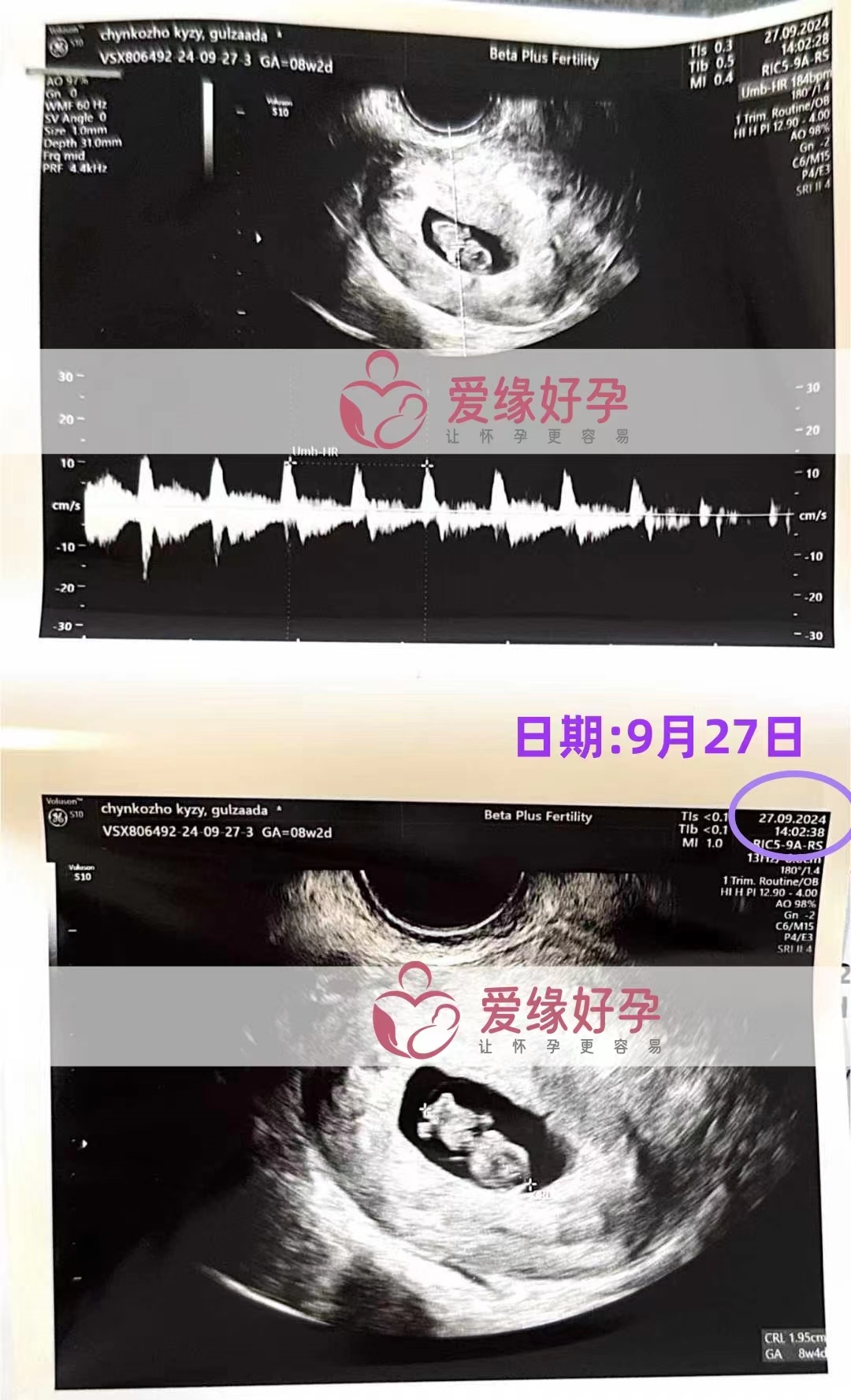 格鲁吉亚代孕代母孕8周产检顺利通过