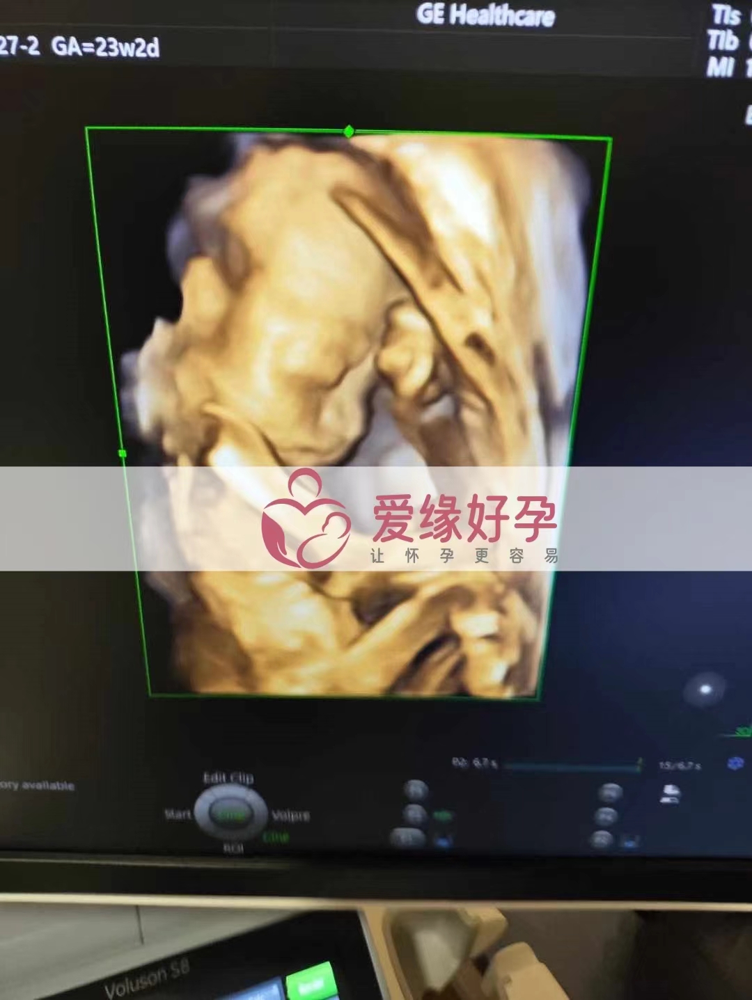 乌克兰代孕代母孕24周产检顺利通过