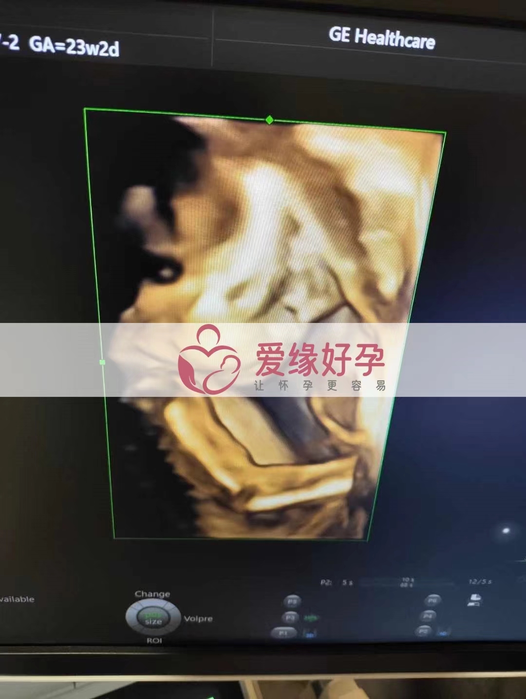 乌克兰代孕代母孕24周产检顺利通过
