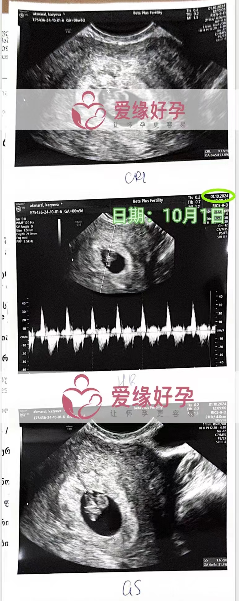 格鲁吉亚代孕代母孕6周产检顺利通过