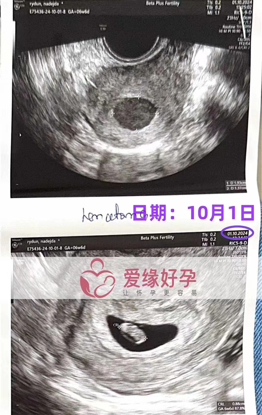 格鲁吉亚代孕代母孕6周产检顺利通过