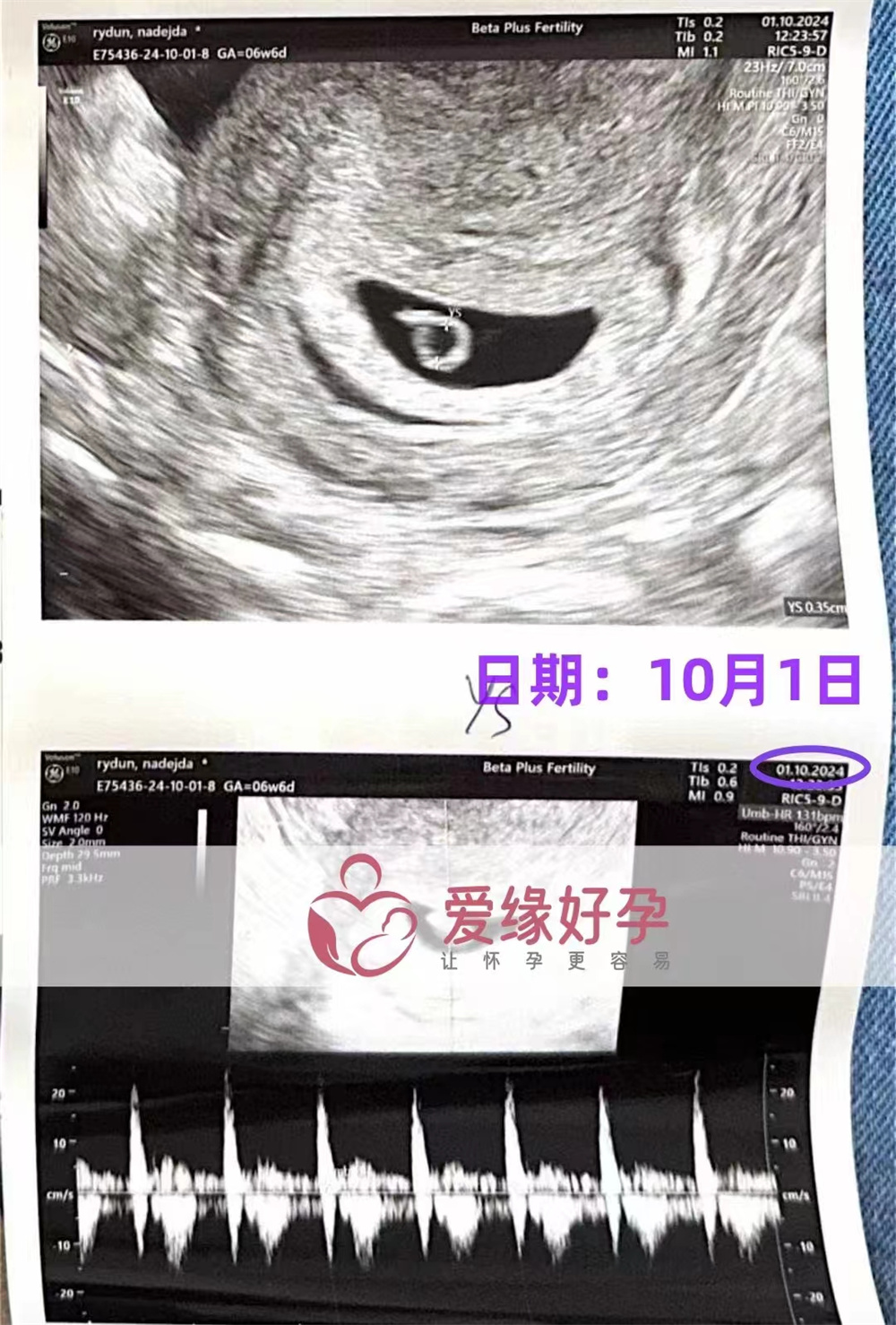 格鲁吉亚代孕代母孕6周产检顺利通过