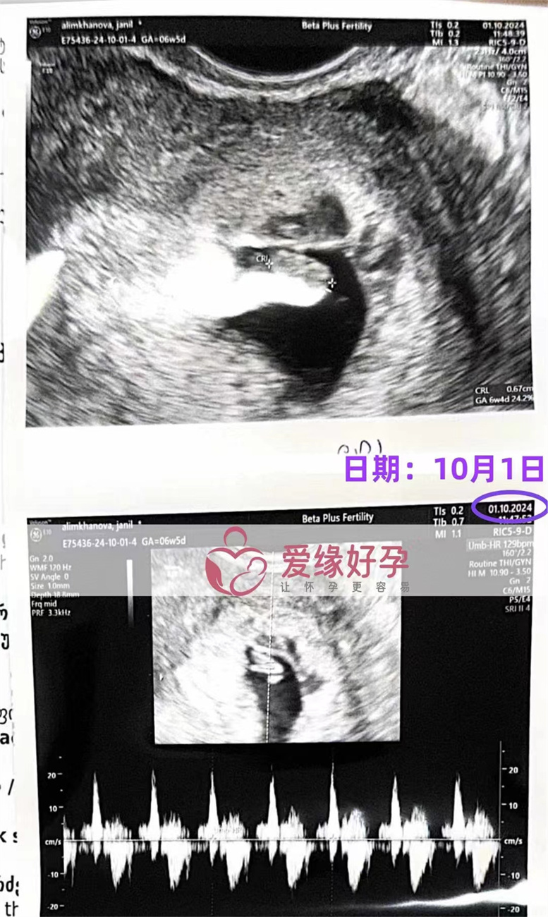 格鲁吉亚代孕代母孕6周产检顺利通过