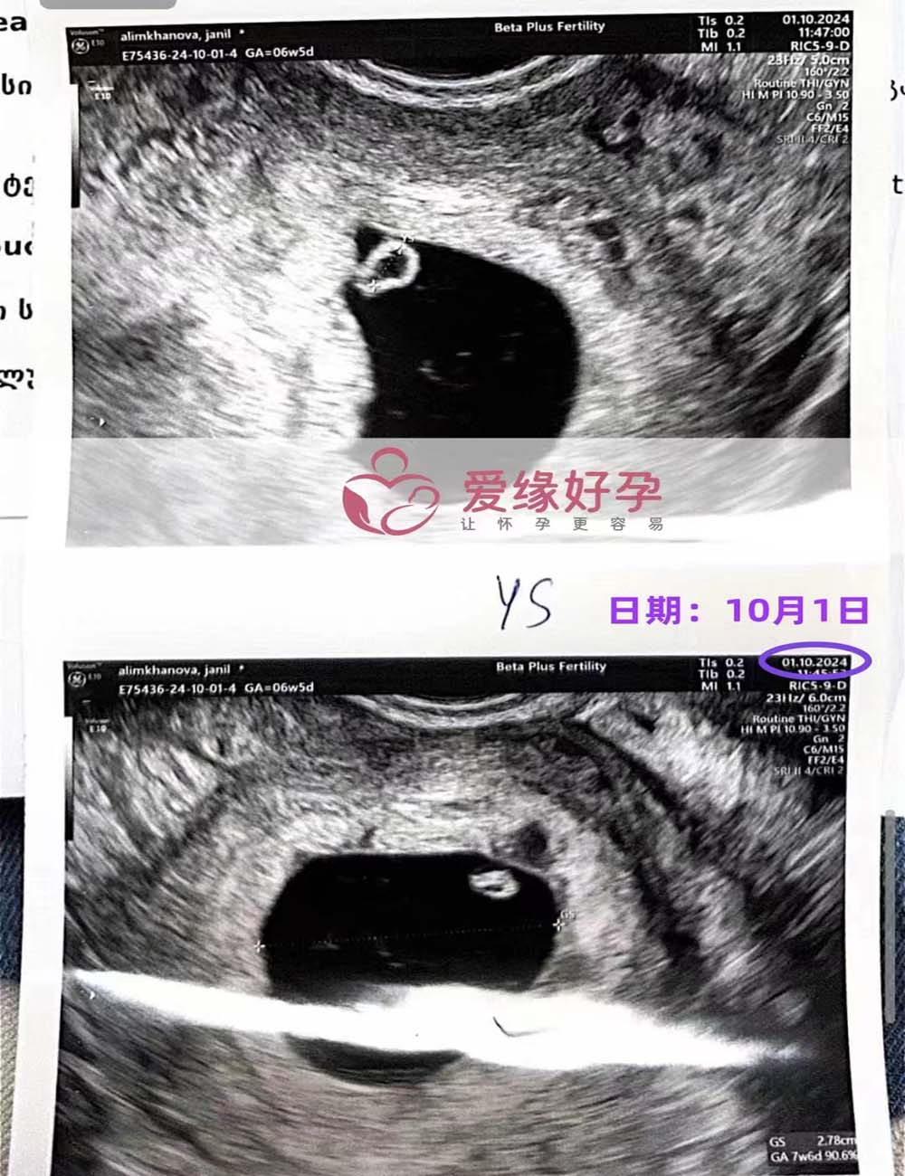 格鲁吉亚代孕代母孕6周产检顺利通过