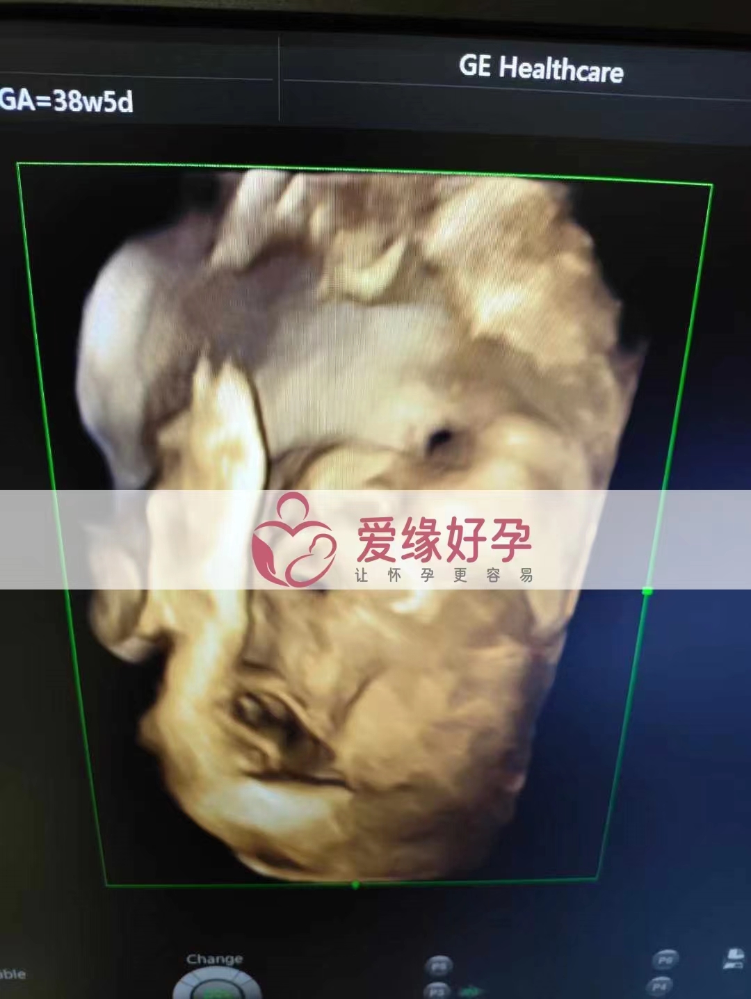 乌克兰代孕代母孕28周产检顺利通过